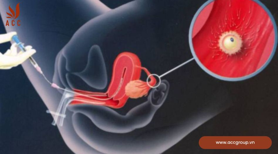 Một số quy định pháp luật về việc cấy, ghép phôi thai